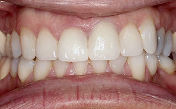 Dental Implant Periodontist Near Me | Houston, TX Affordable Dental Implants | Dental Implants ...